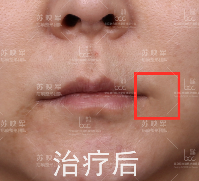 嘴角疤痕增生惹烦恼,非手术综合治疗重新绽放灿烂笑容 - 好大夫在线