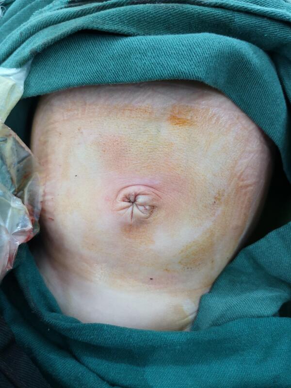 脐膨出术后图片图片