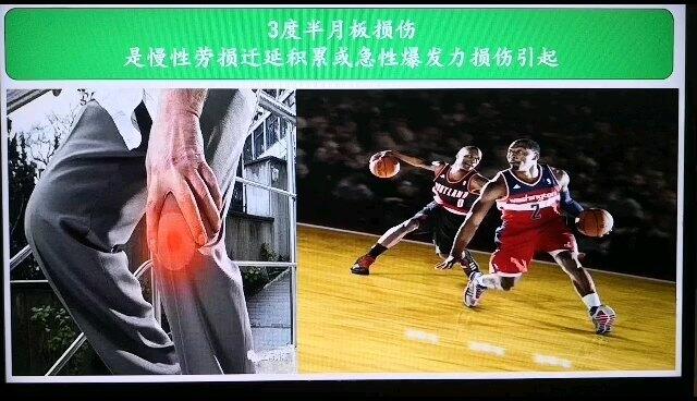 明明没有受伤，怎么我的半月板就损伤了？
