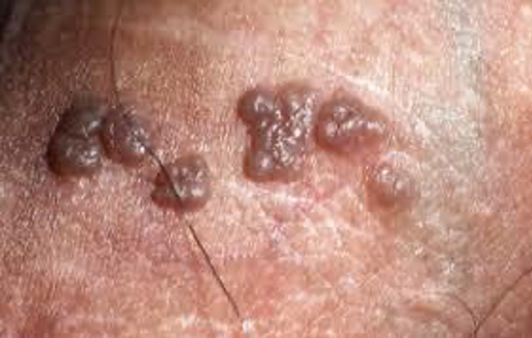 欧洲龟头炎 龟头包皮炎诊疗指南解读3 肿瘤因素 图片可能引起不适请谨慎点击 包皮龟头炎 好大夫在线