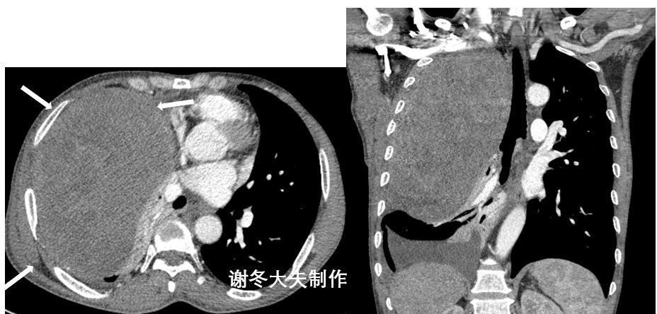 纵隔肿瘤_纵隔肿瘤相关疾病 - 好大夫在线
