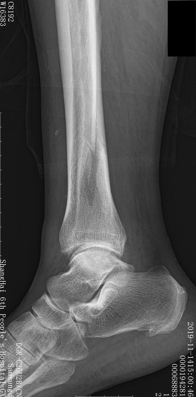 腓骨骨折需要手术吗 胫腓骨骨折 腓骨骨折需要手术吗 胫腓骨骨折