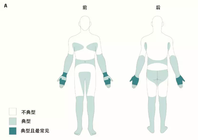 2020版疥疮国际诊断标准_疥疮_发病原因_症状表现 - 好大夫在线