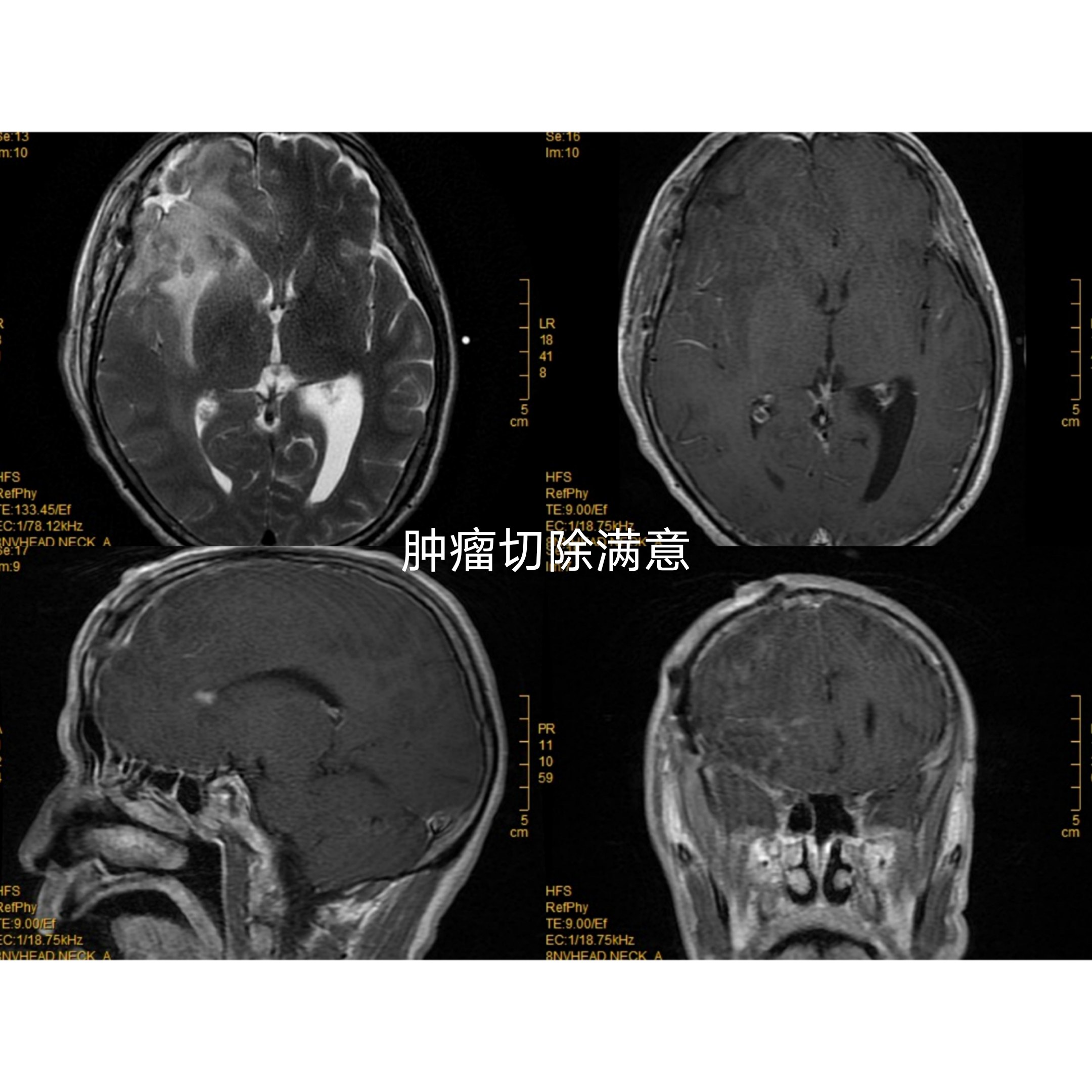 近期功能区胶质瘤3例总结