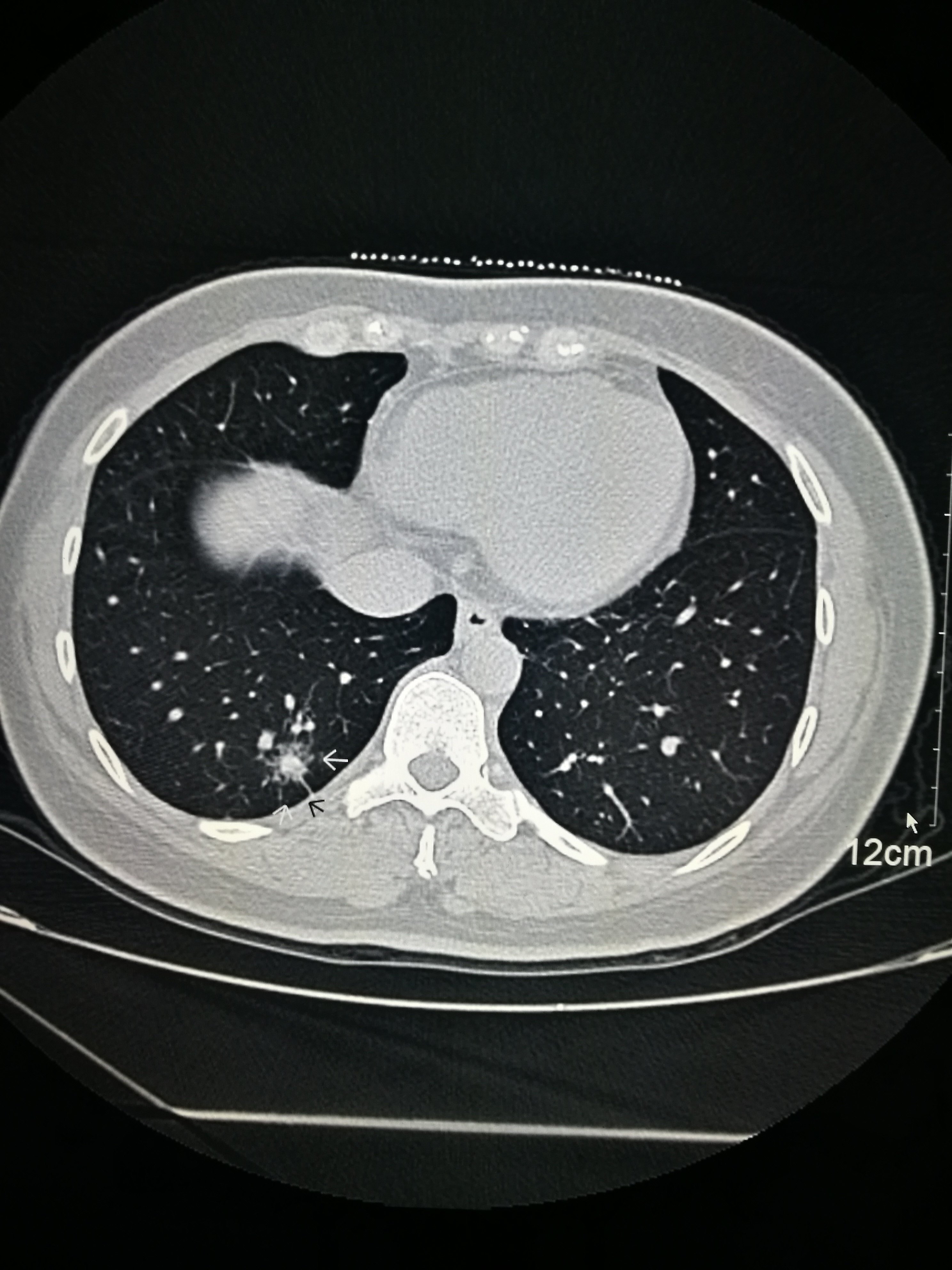 39岁年轻患者因咳嗽于当地行肺部ct,发现右下肺混合磨玻璃密度结节