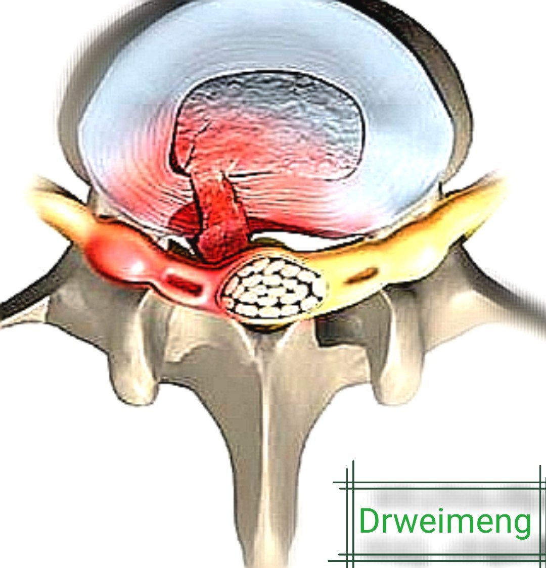 腰间盘突出是什么样子图片