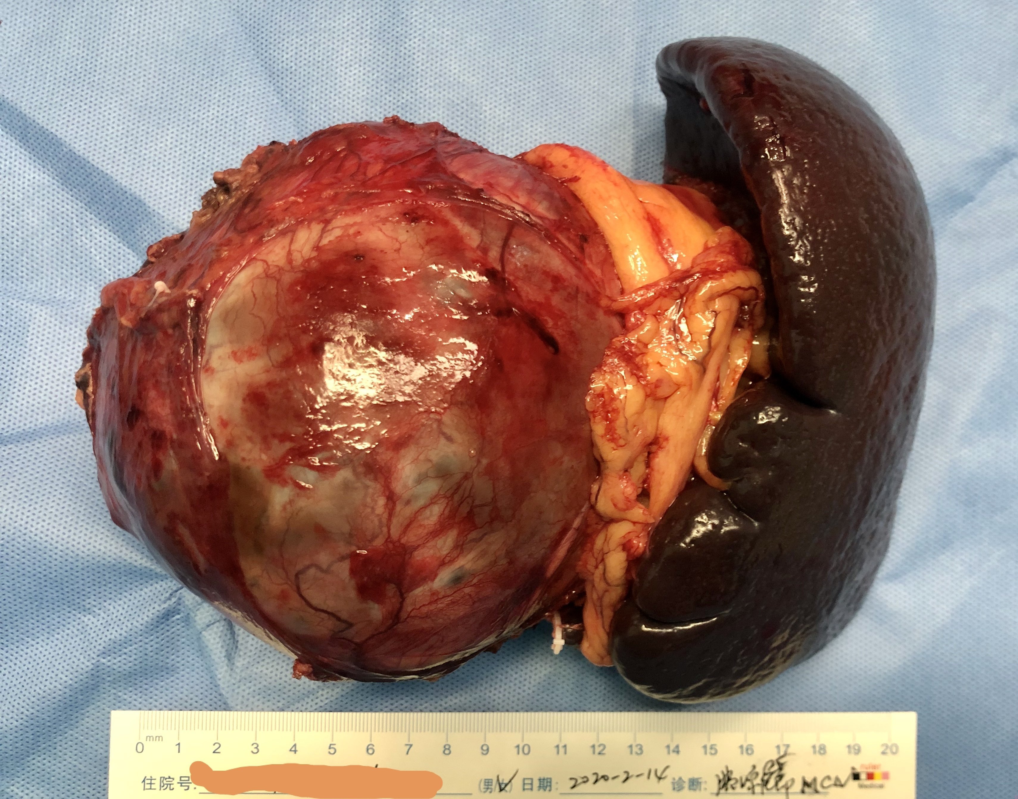 2020-02-14妊娠伴胰腺巨大粘液性囊腺瘤 - 好大夫在線