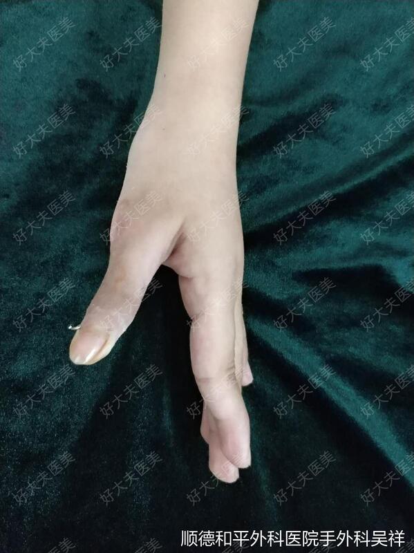 诊断:左拇指先天性多指畸形切除术后桡偏畸形患者为左拇指多