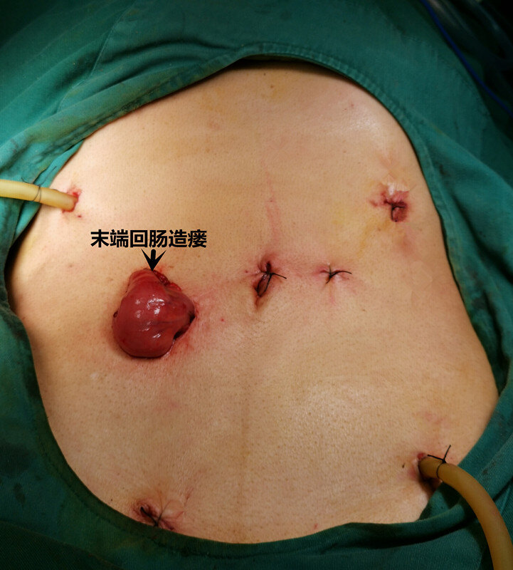 罕见的腹腔镜下大手术 