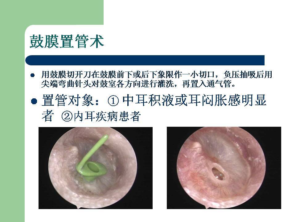 希望更多的患者瞭解耳內鏡治療及手術