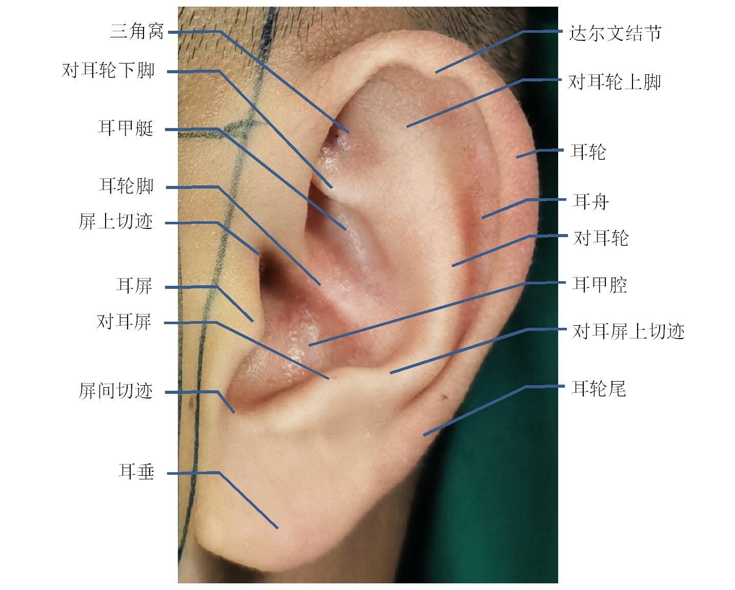 耳廓整形 常见先天性耳廓畸形 耳部整形 好大夫在线 耳廓整形 常见先天性耳廓畸形 耳部整形 好大夫在线