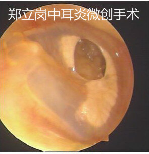 儿童中耳炎鼓膜穿孔 需要做手术吗 鼓膜穿孔 鼓膜穿孔