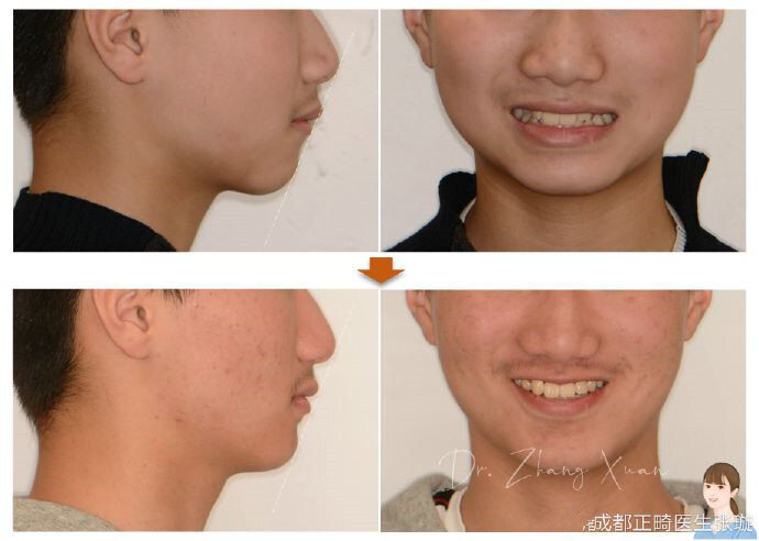 今日分享-拔除"侧切牙"固定矫治案例 - 好大夫在线