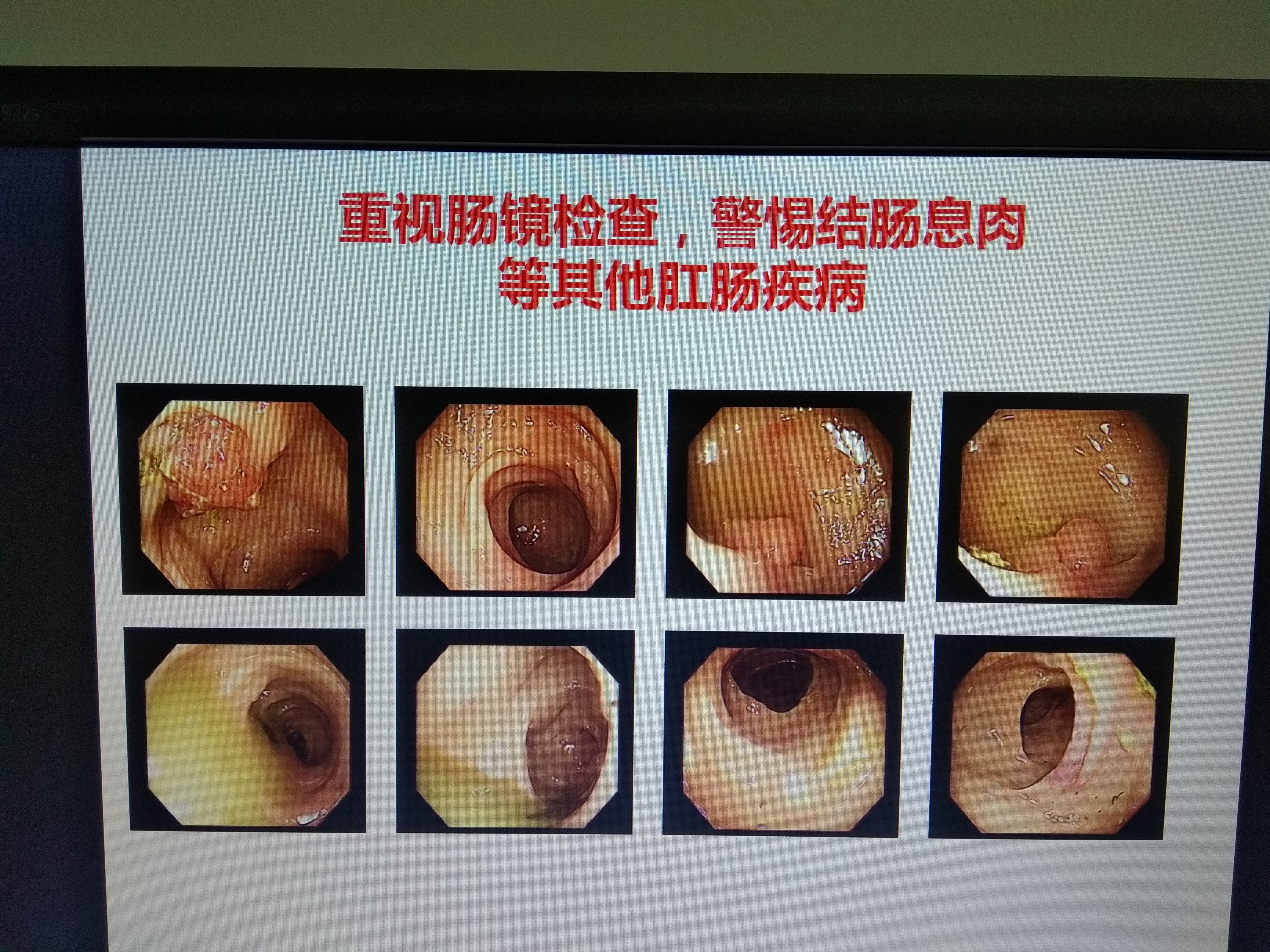 重視腸鏡檢查,警惕結腸息肉等其他肛腸疾病!(二十三)