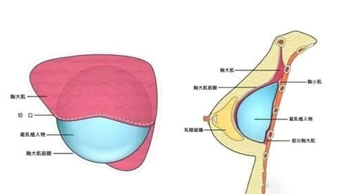 23萬隆胸居然做出四個胸做乳房懸吊假體隆胸假體要放在哪個層次