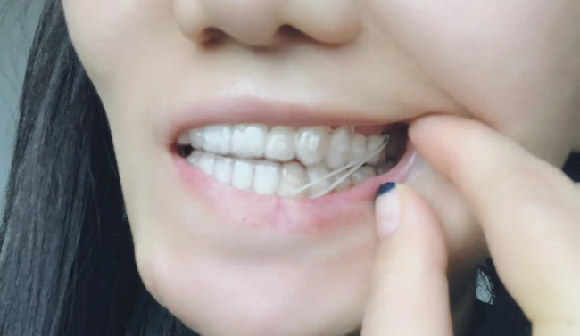 牙齿矫正为什么要挂皮筋 张栋梁教授正畸科普 牙颌畸形 好大夫在线 牙齿矫正为什么要挂皮筋 张栋梁教授正畸科普 牙颌畸形 好大夫在线