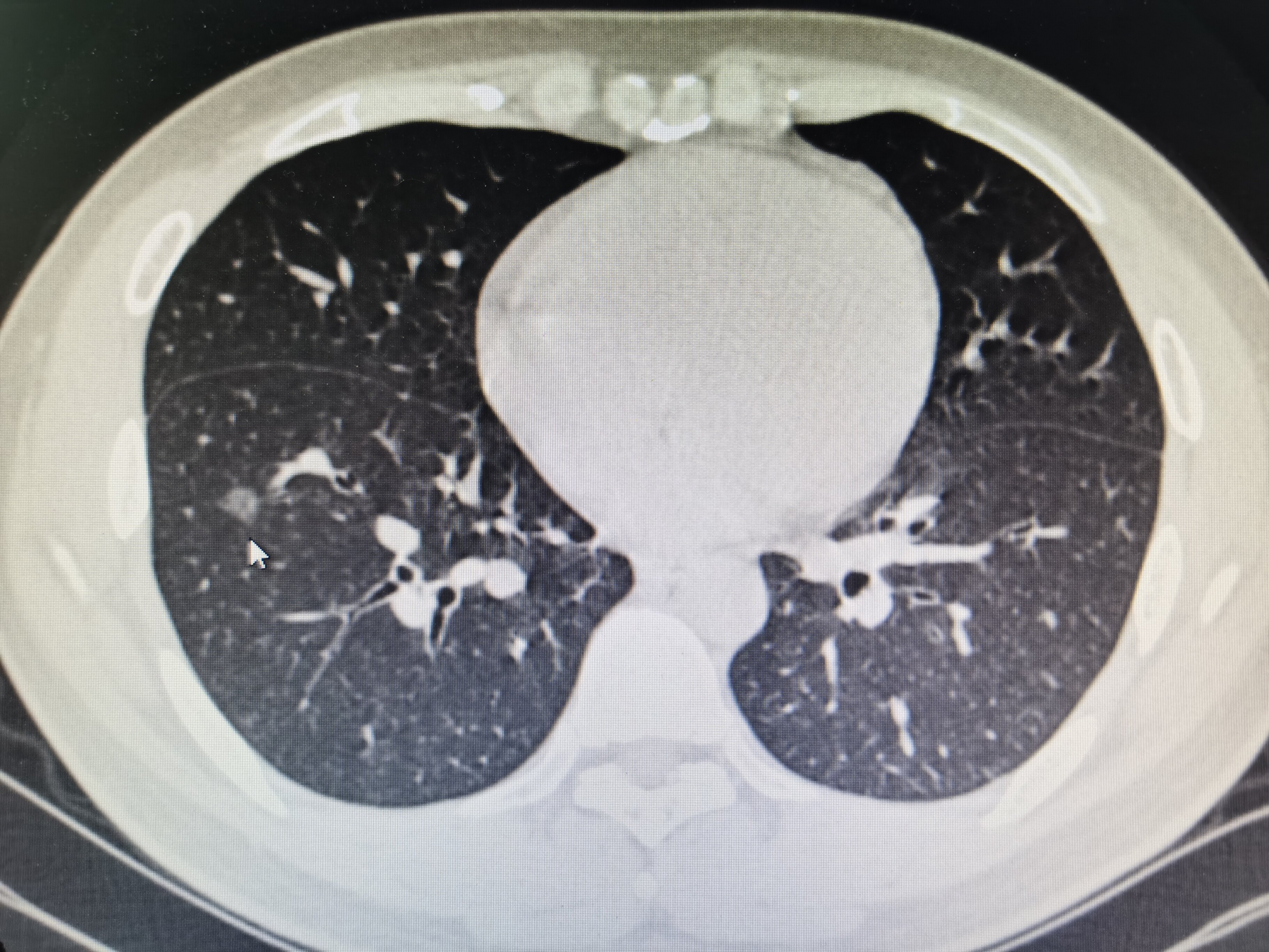 肺部结节 肺部结节