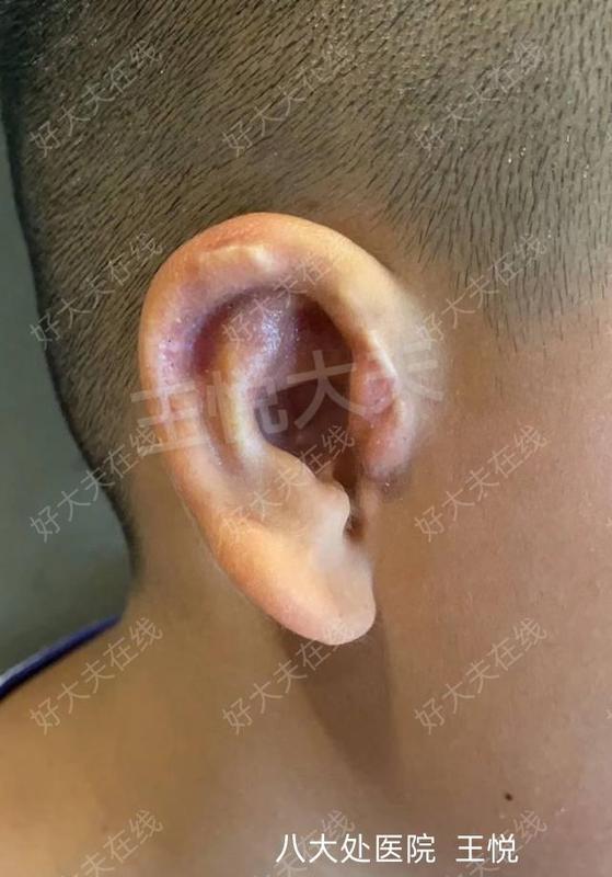 治疗后210天治疗后7岁的小男孩不止是小耳畸形,耳甲腔也有畸形,一起做