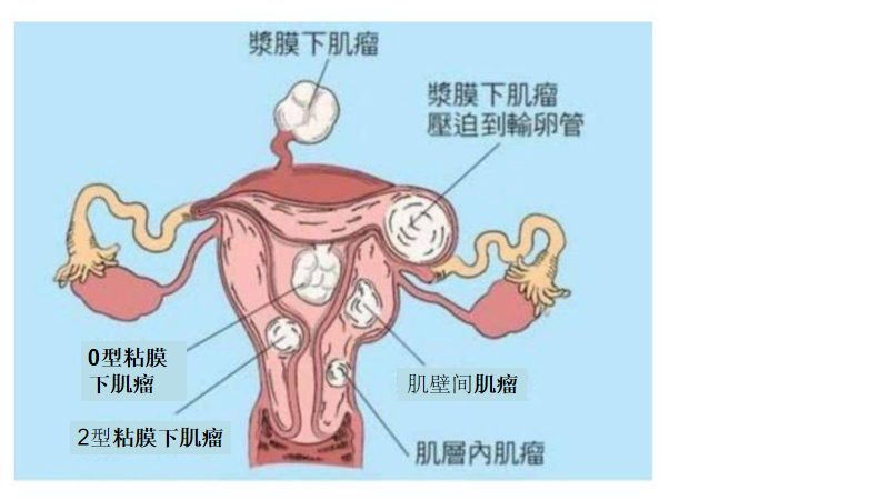 子宮肌瘤按所在部位分為三類:漿膜下肌瘤,肌壁間肌瘤和粘膜下肌鯔