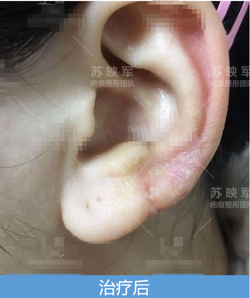 耳朵经重新"装修"现已焕然一新