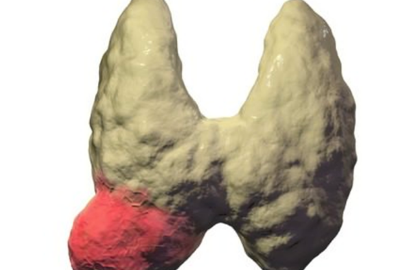 如何科学筛查甲状腺癌?