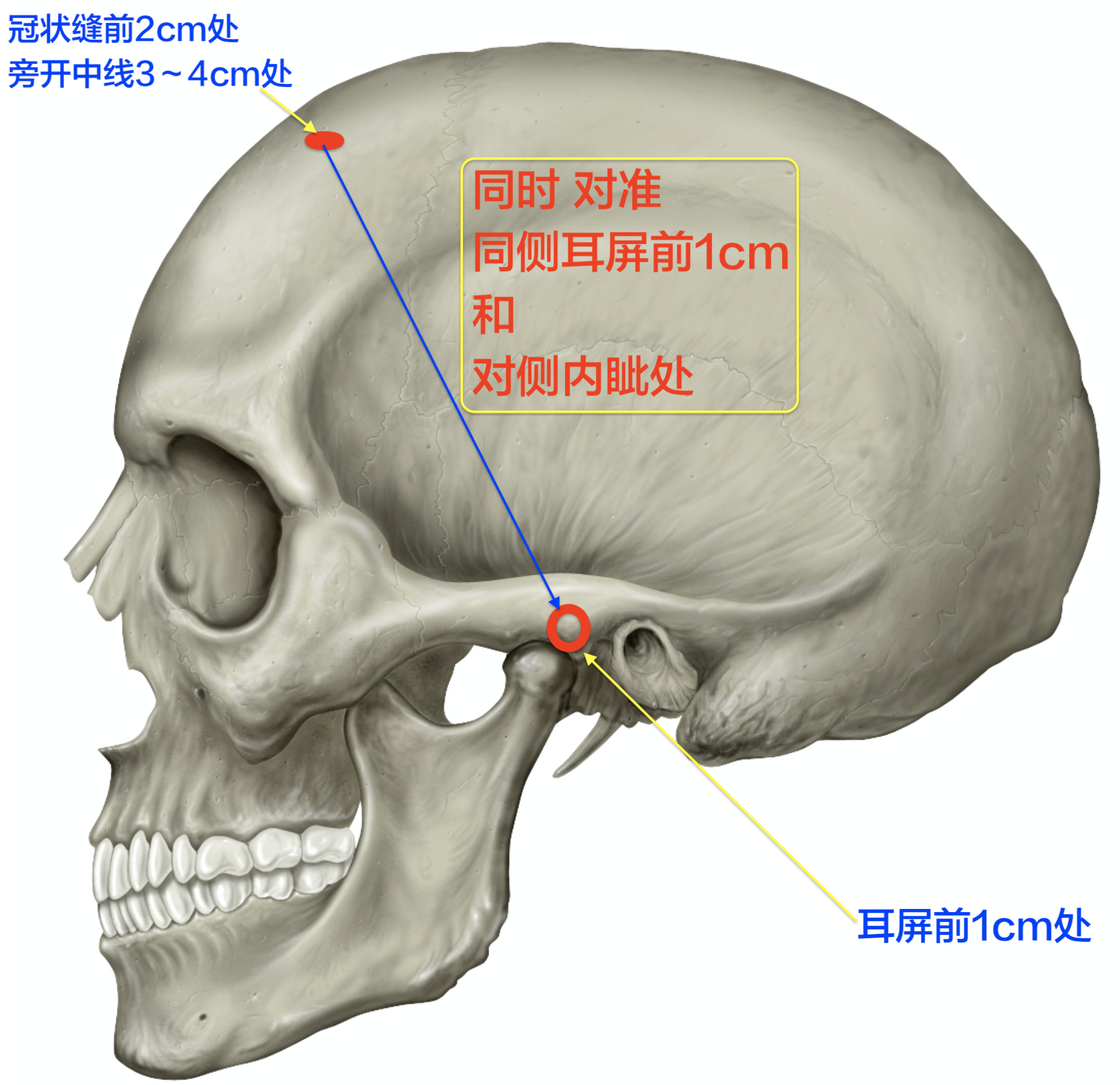 侧脑室前角穿刺 - 好大夫在线