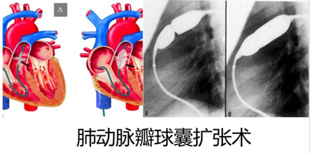 開胸手術近年來逐漸減少,往往是合併其它心臟畸