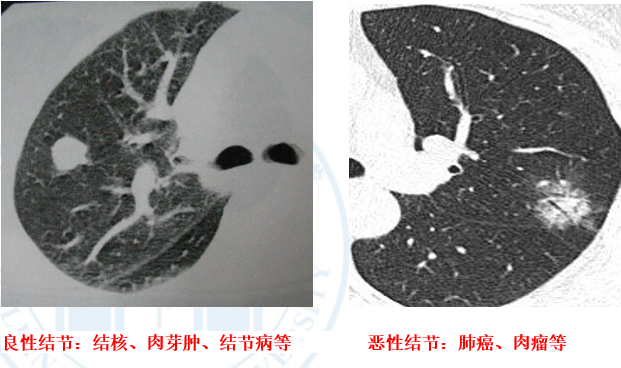 可分為良性結節和惡性結節.