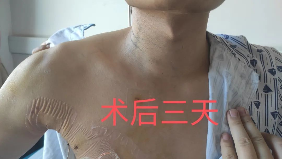 王培松副主任医师为一位巨大甲状腺结节患者实施经腋窝腔镜甲状腺手术