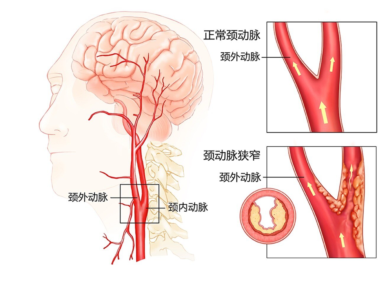 颈部中医动脉治疗斑块效果好吗_颈部中医动脉治疗斑块的方法_颈部动脉斑块治疗中医