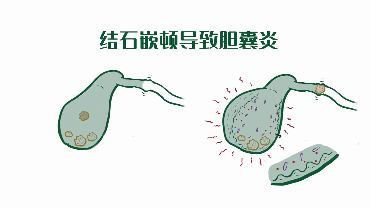 有了胆囊炎或胆结石,要切胆么_胆囊炎 - 好大夫在线