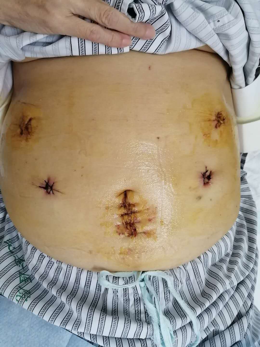 胰腺微创:助患者术后加速恢复