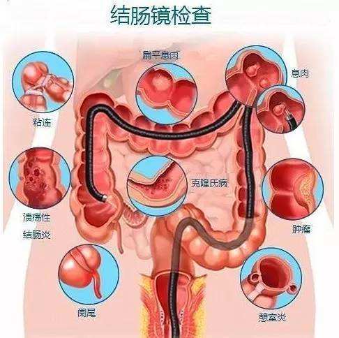 结肠镜检查图片.jpg