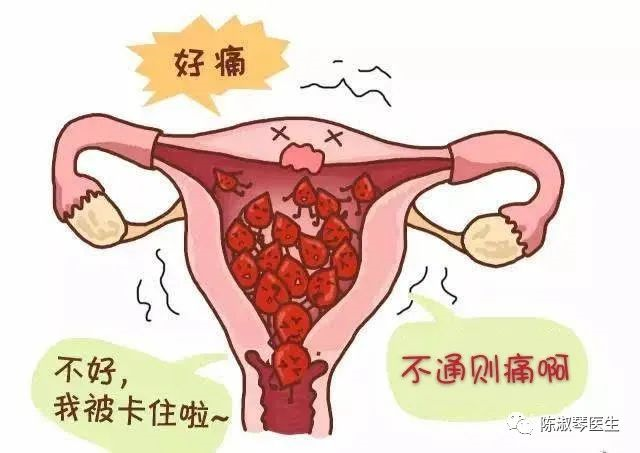 子宫内膜异位卡通图片