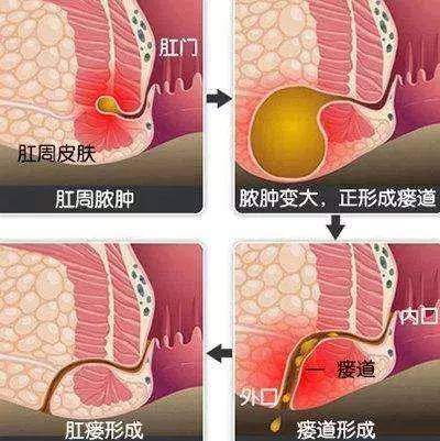 高位肛瘘位置图片