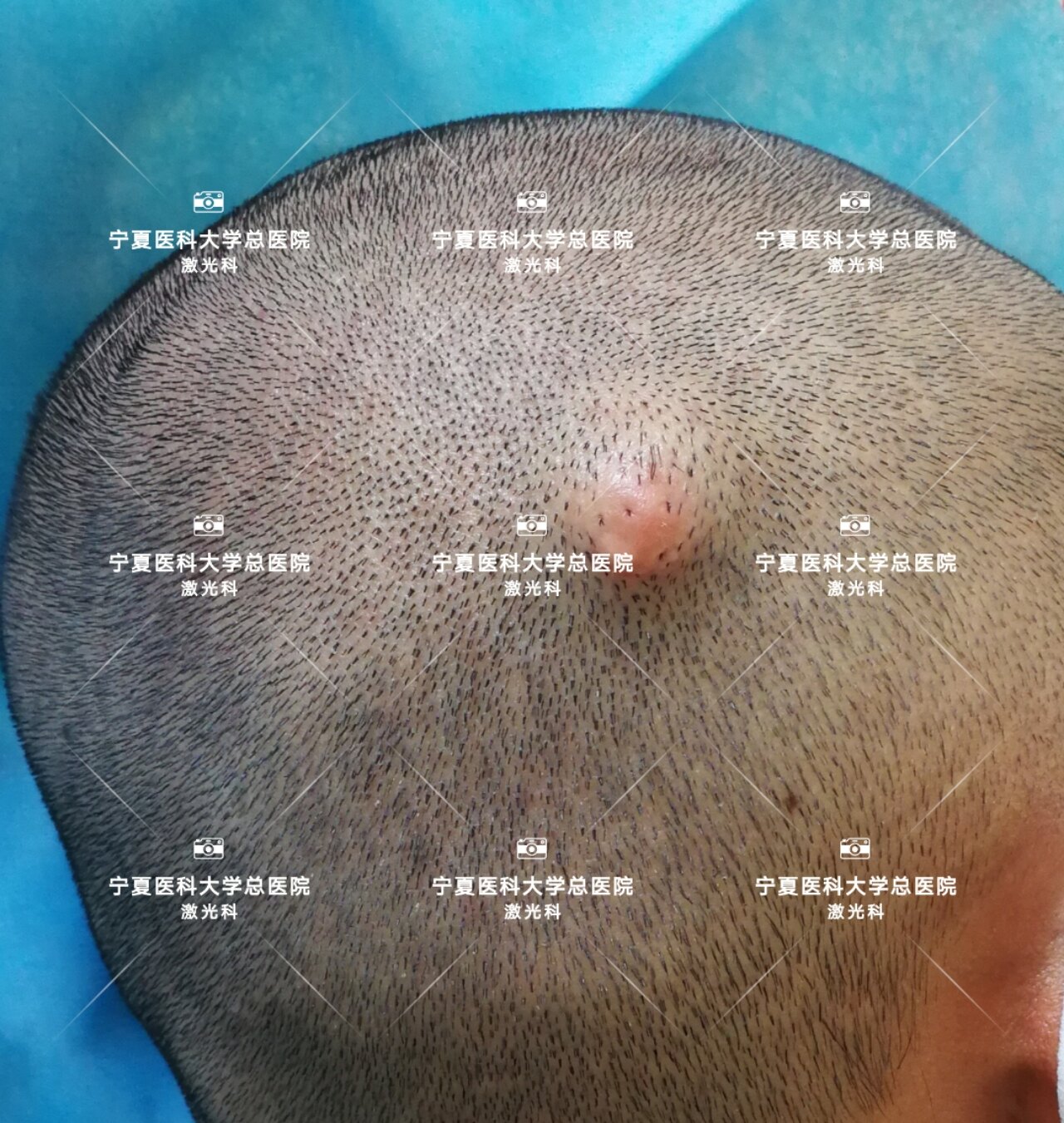 头皮肿物切除术步骤图片