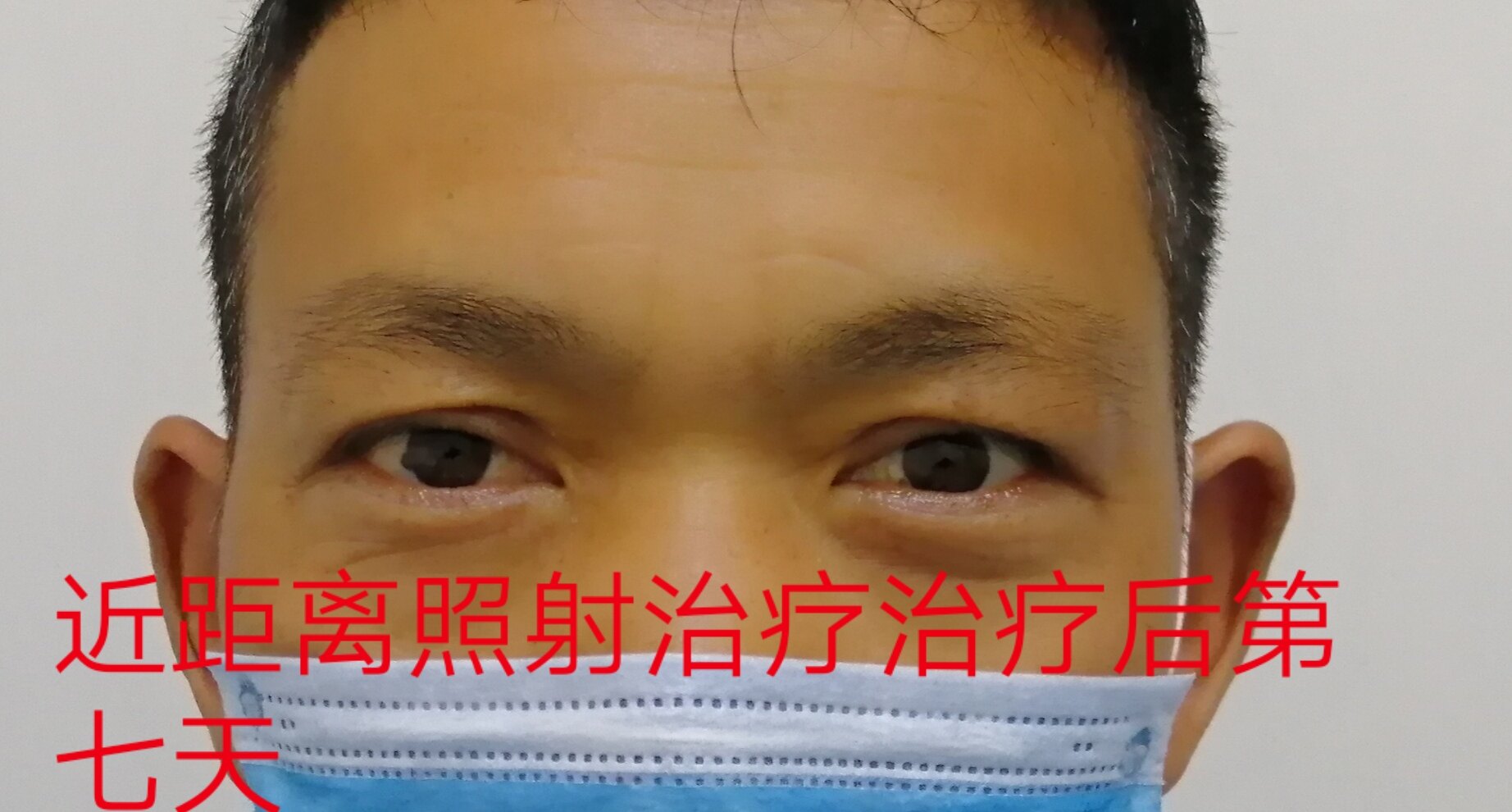 甲亢突眼的早期治疗很重要_甲亢突眼_甲亢突眼缓解方法 - 好大夫在线