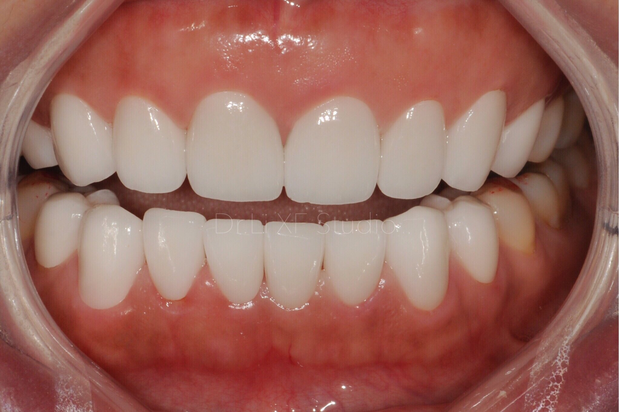 前牙美学修复_口腔修复_口腔修复治疗介绍 - 好大夫在线