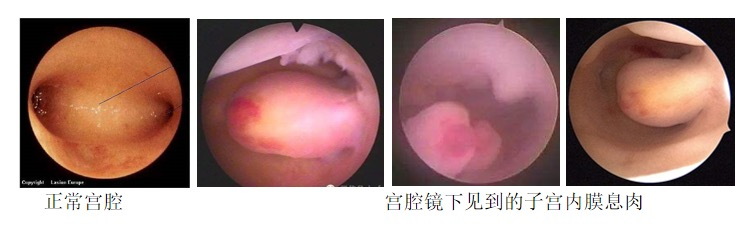 女性尿道息肉手术过程图片
