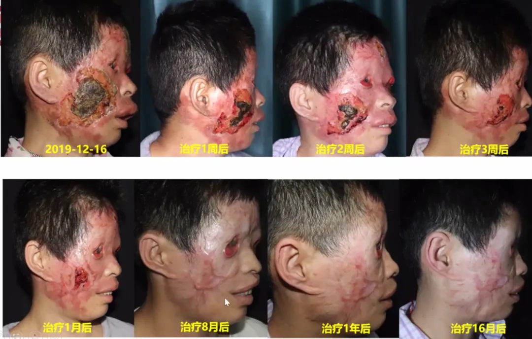 治疗情况及预后诊断实验室检查患者初次就诊面部红斑16年,溃疡结痂4年