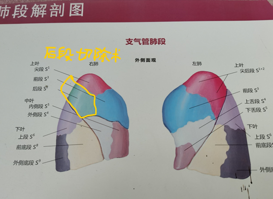 肺段的划分图片图片