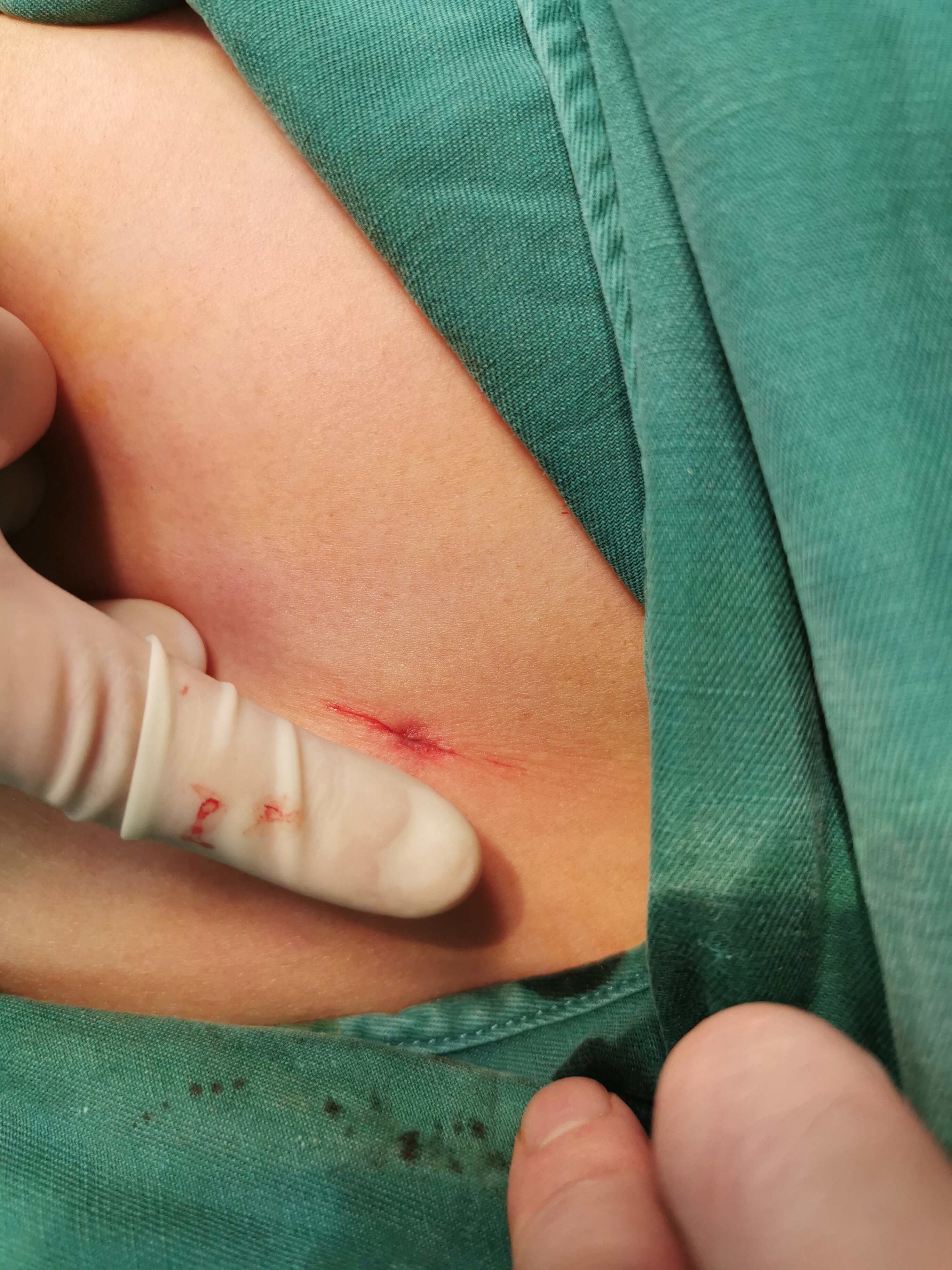 欧洲禁止手汗症手术图片