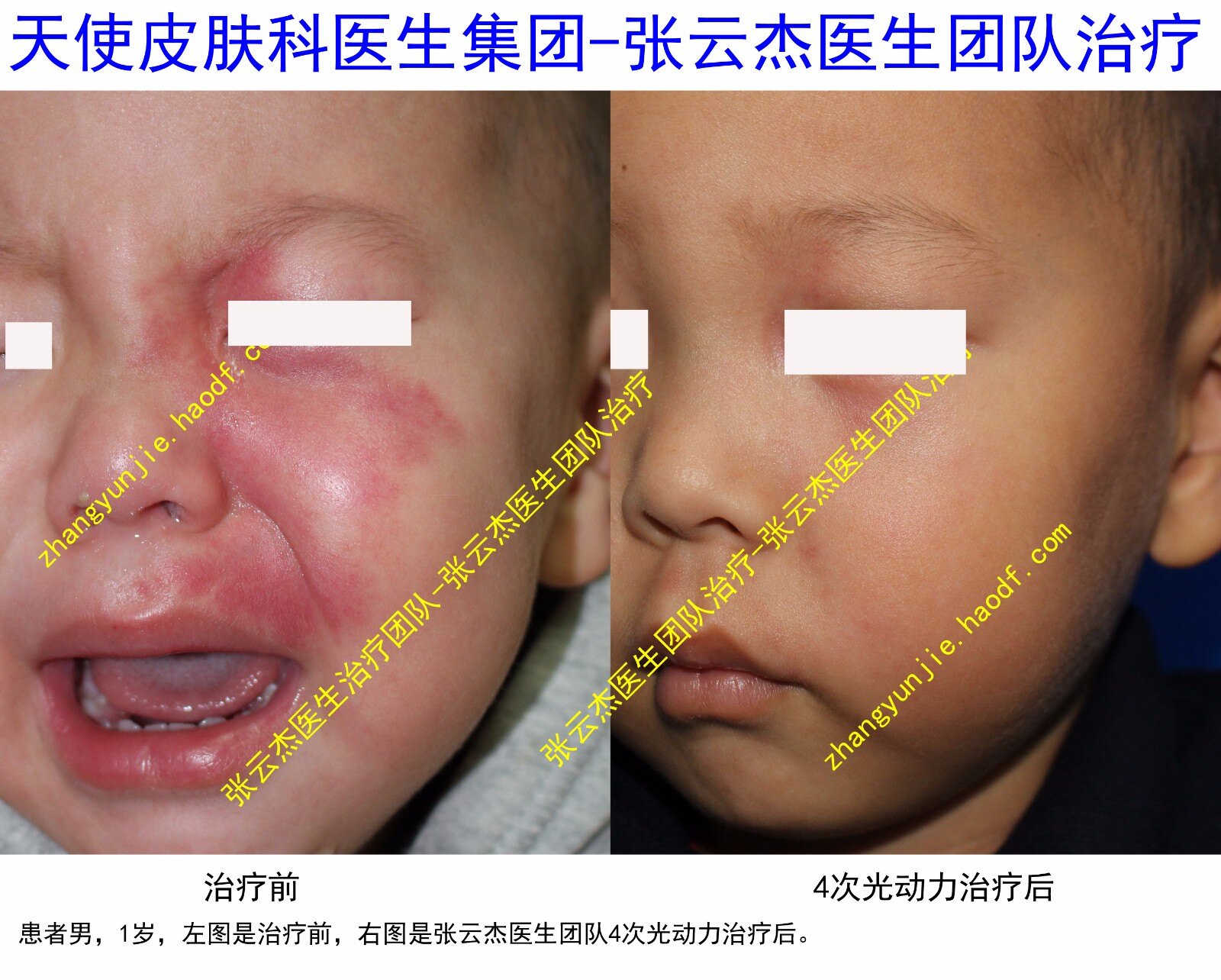海姆泊芬光动治疗后的饮食注意事项 鲜红斑痣