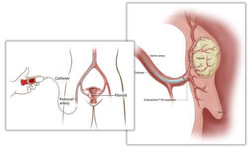 介入治療:子宮肌瘤的全新微創治療方法