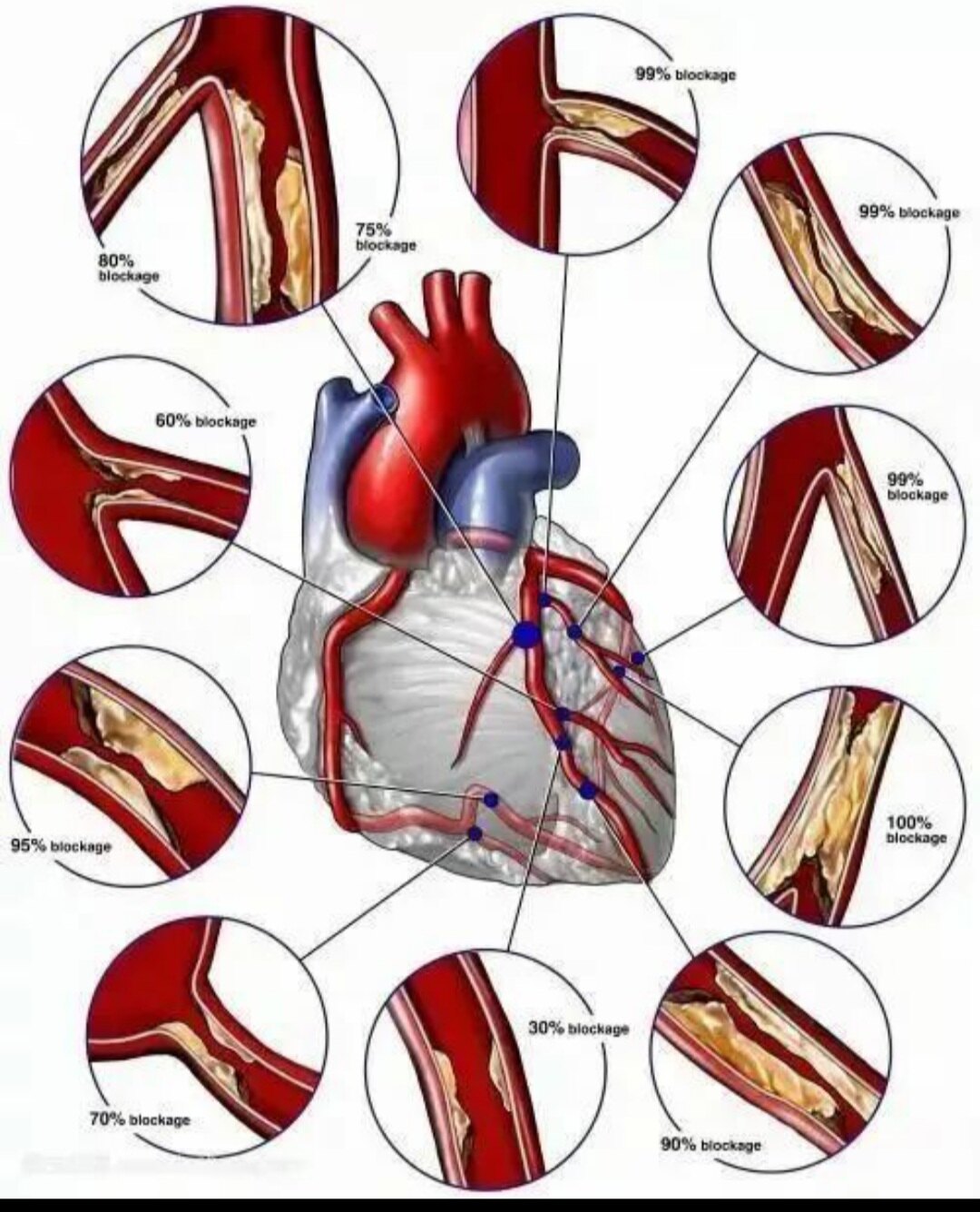 冠状动脉粥样硬化狭窄程度图解