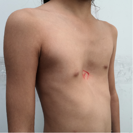 7岁女孩漏斗胸的微创手术治疗 漏斗胸 漏斗胸
