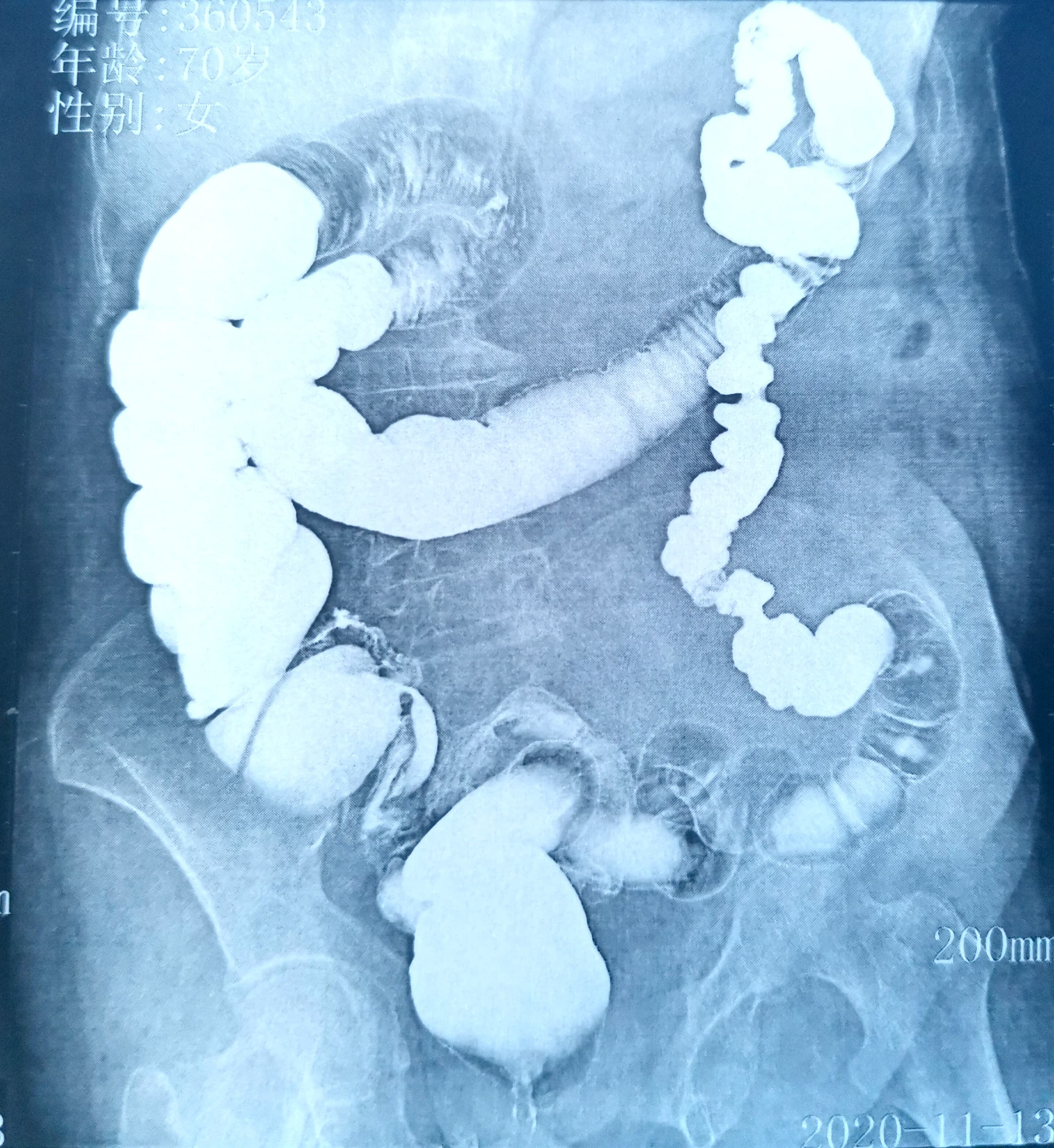 巨结肠肚子图片