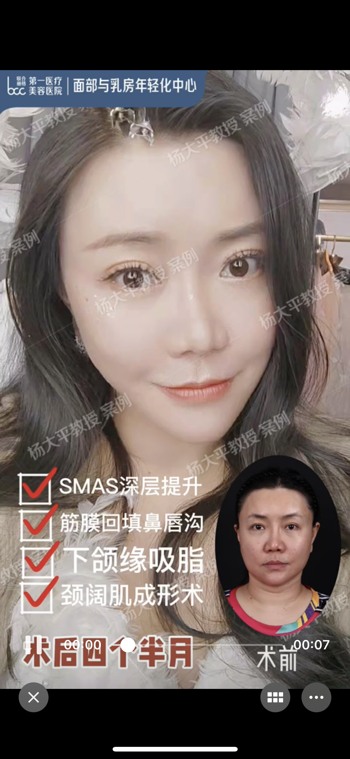 手術方式選擇了面頸部smas深層提升,改善面部綜合衰老症狀,配合下頜緣