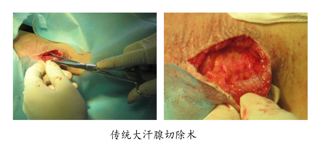 手汗腺切除术图片