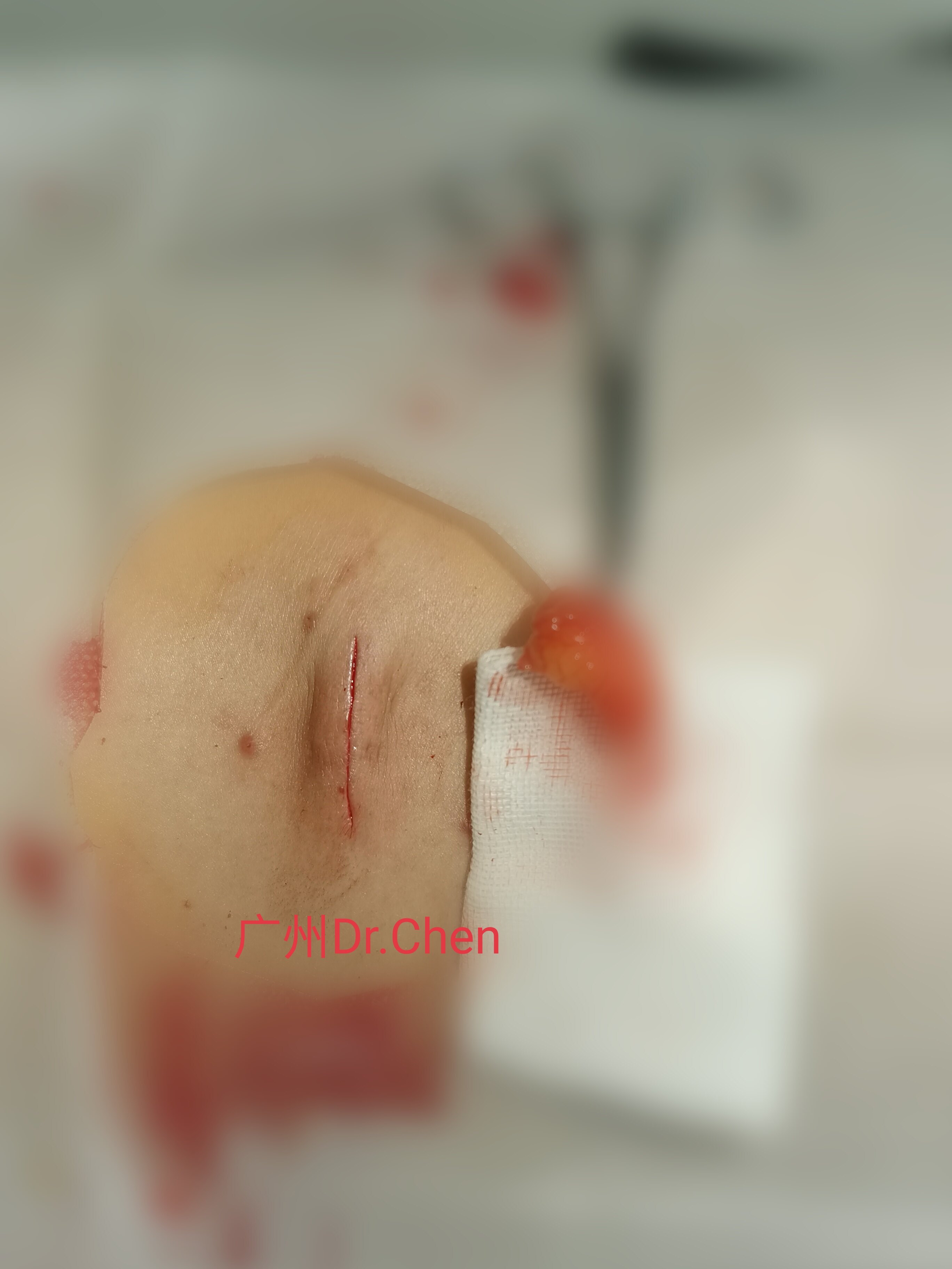 脂肪瘤刀口恢复图片图片